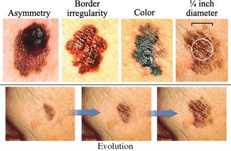 Source http://www.webmd.com/melanoma-skin-cancer/abcds-of-melanoma-skin-cancer