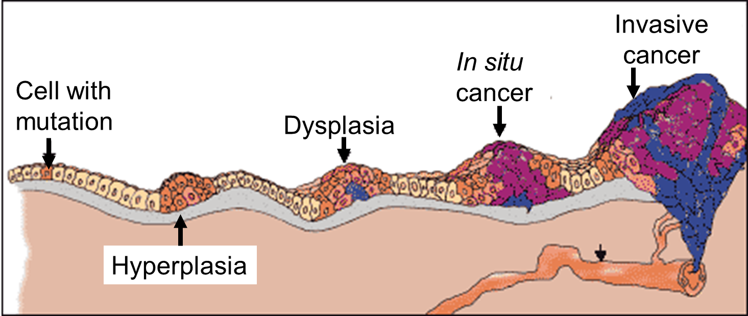 Evolution of a Cancer